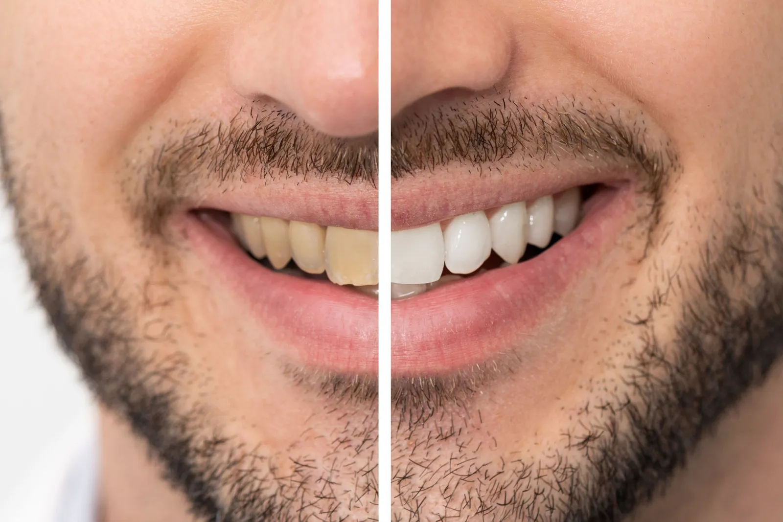 Before and after a cosmetic smile transformation