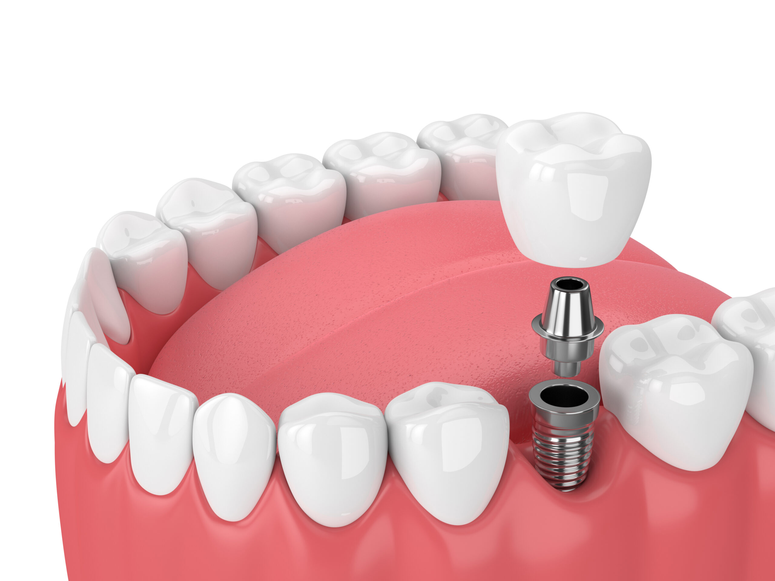 Dental Implants in Downey: Candid Costs, Timelines, and Financing ...